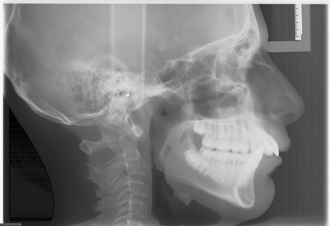 What Is An Overbite?