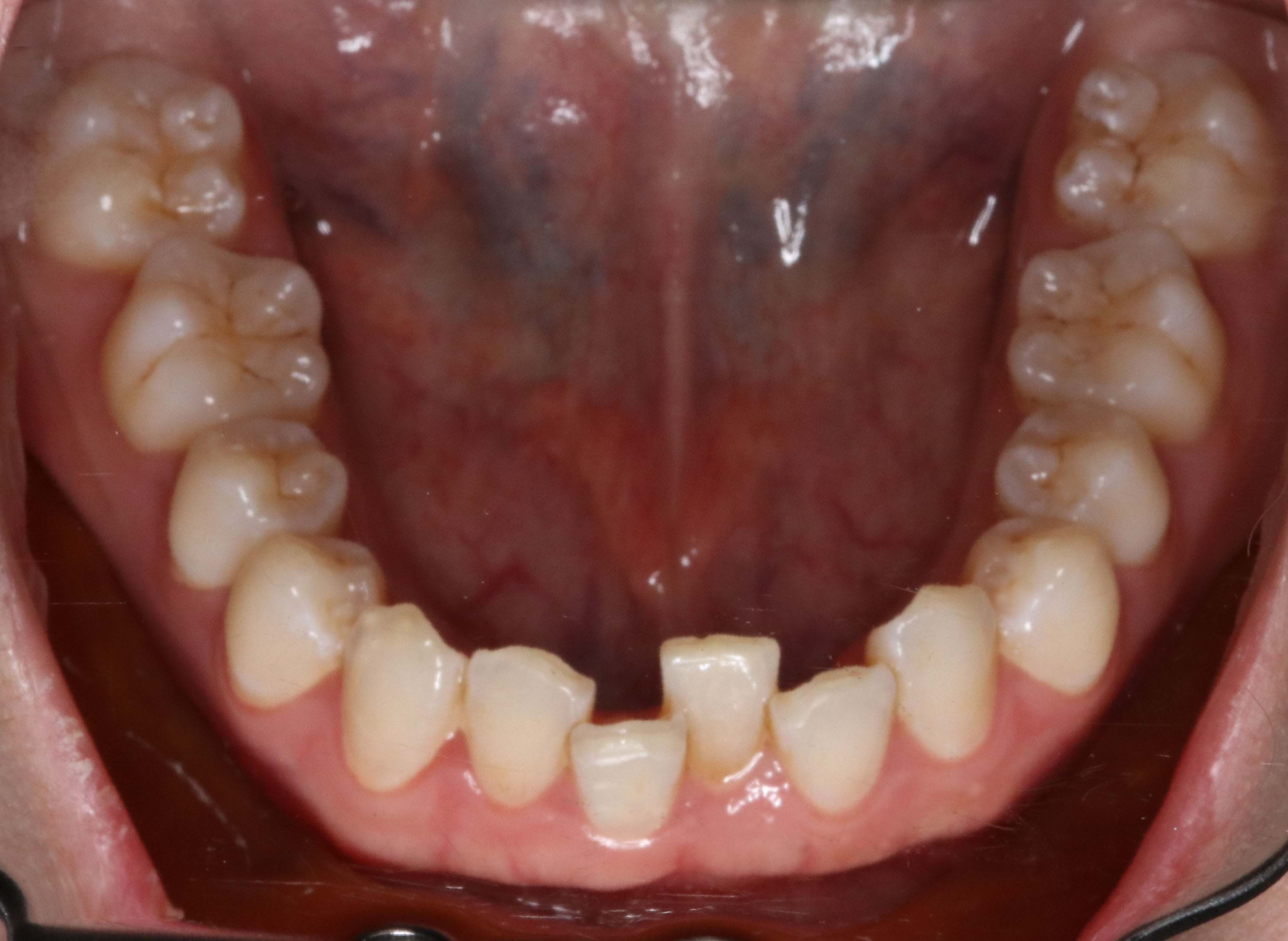 Orthodontic Relapse in Adults