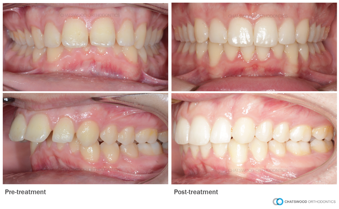 What Is An Overbite?