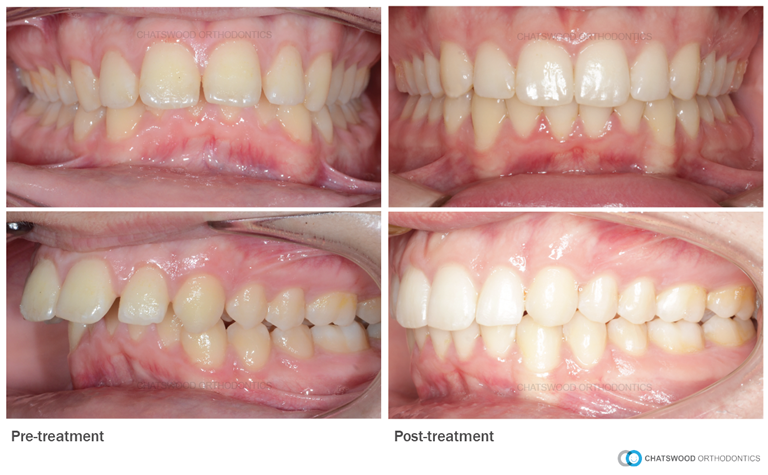 What Is An Overbite?